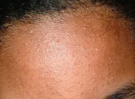 Comedonal acne