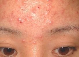 Inflammatoire acne